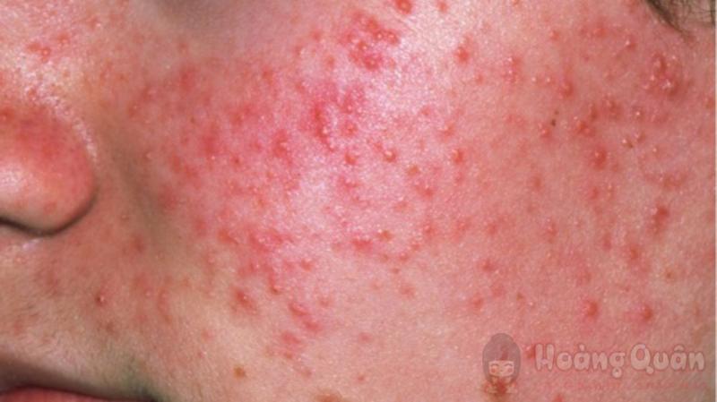 tìm hiểu peel da nhiều có tốt không tìm hiểu peel da nhiều có tốt không