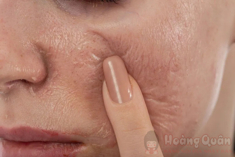 peel da bị thâm