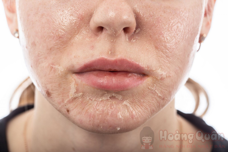 da bị thâm sau peel