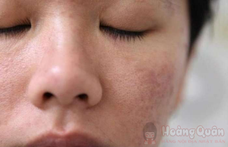 nguyên nhân sau khi peel da bị thâm