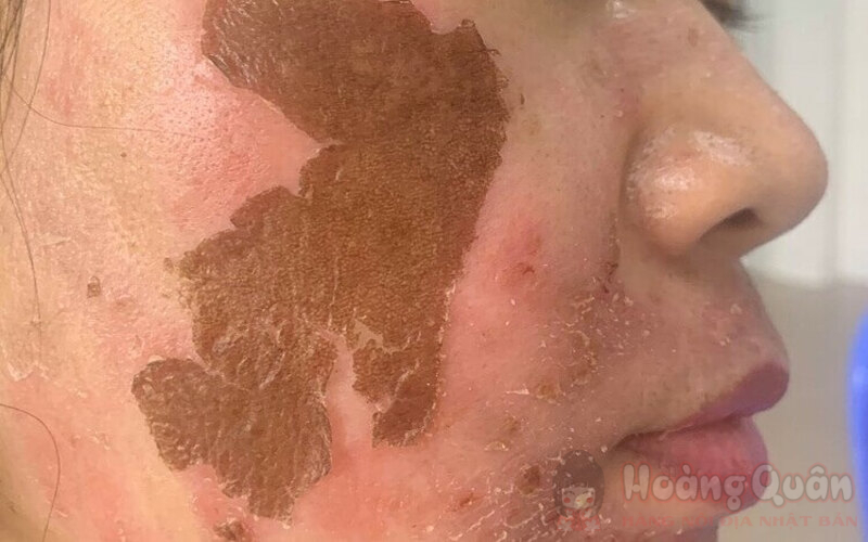 nguyên nhân da bị thâm sau peel