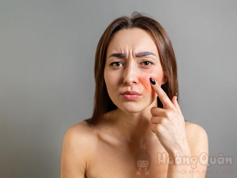 peel da bị ngứa
