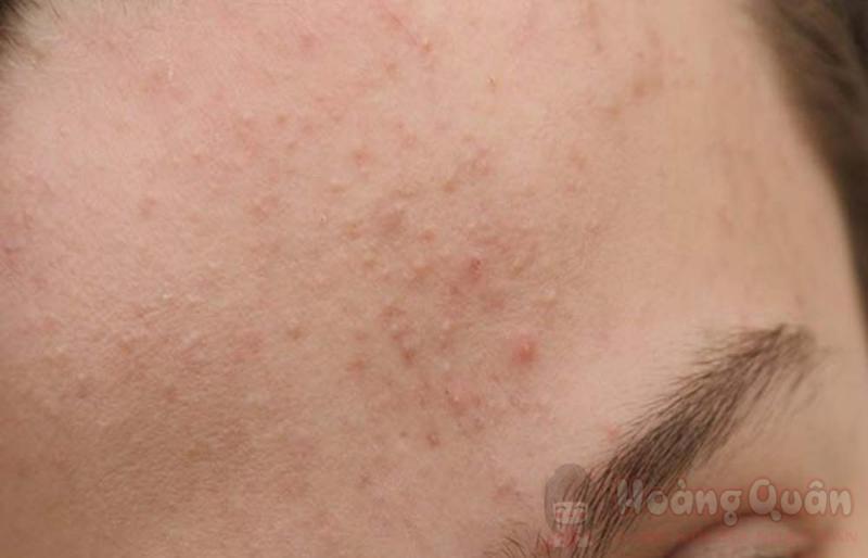 nguyên nhân peel da bị ngứa