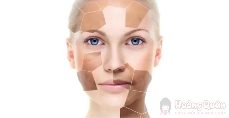 da bị tăng sắc tố sau peel