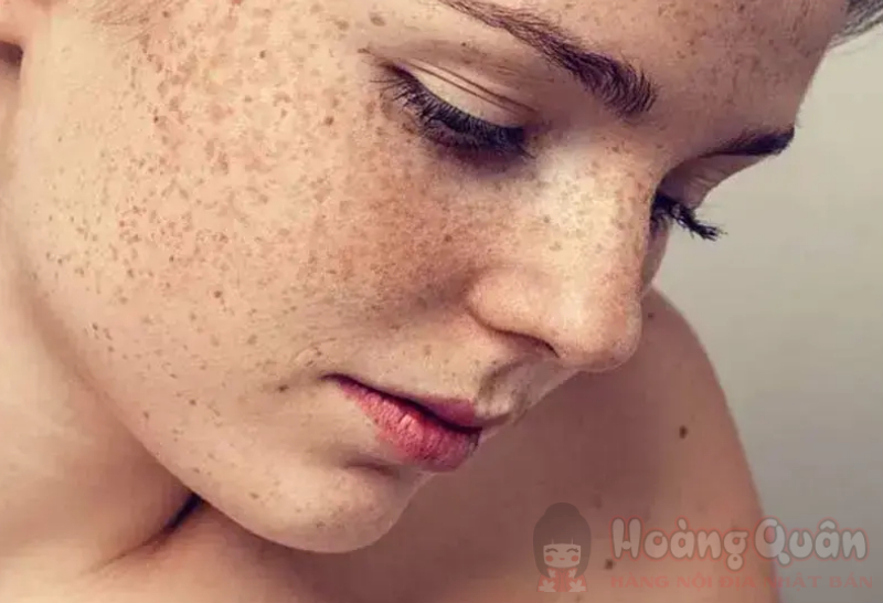 nguyên nhân da bị tăng sắc tố sau peel