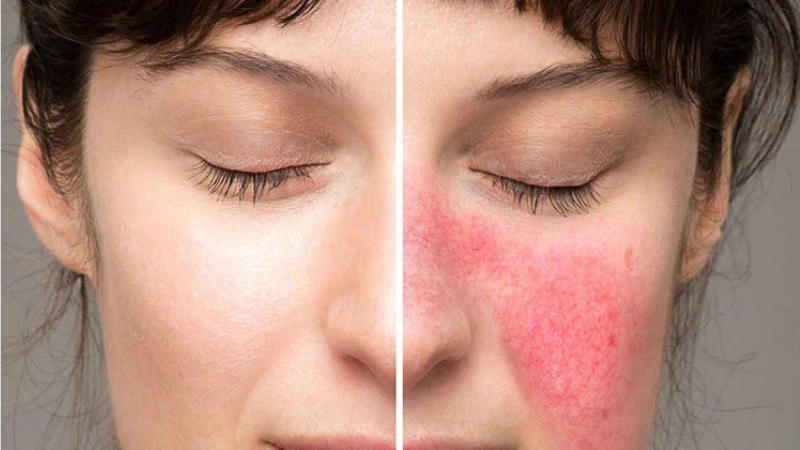 peel da xong bị đỏ