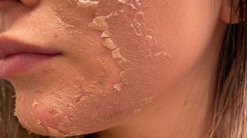 da bị đỏ sau khi peel