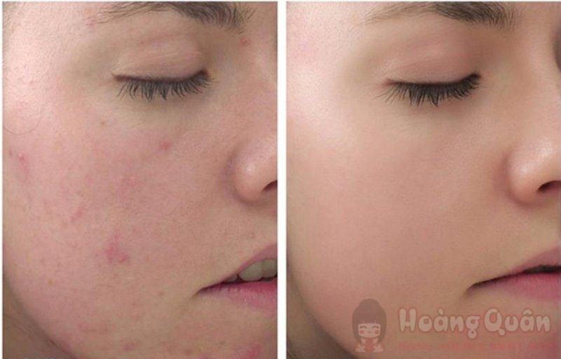 các bước peel da tại nhà