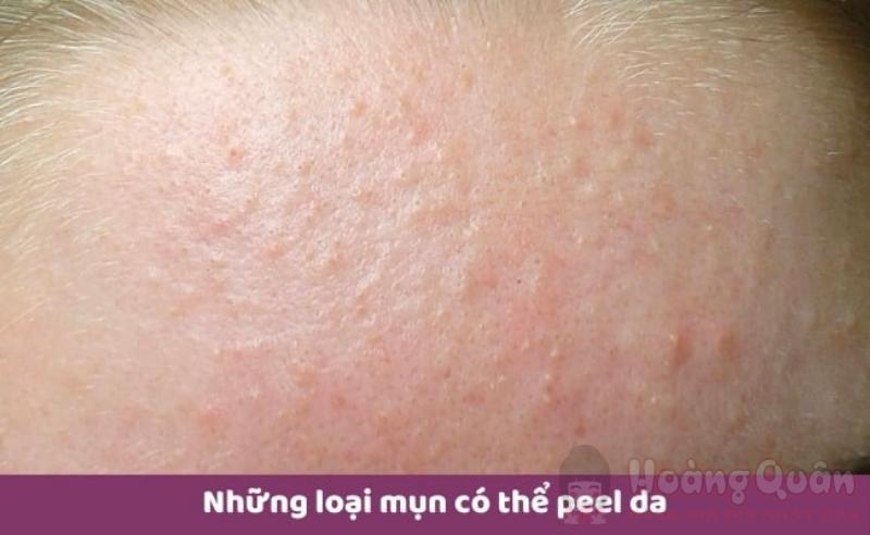 sau khi nặn mụn có nên peel da