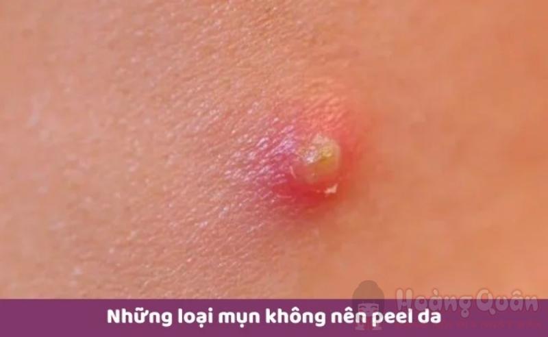 sau khi nặn mụn có nên peel da không