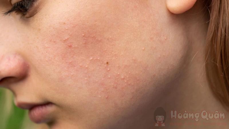 vừa nặn mụn xong có nên peel da không