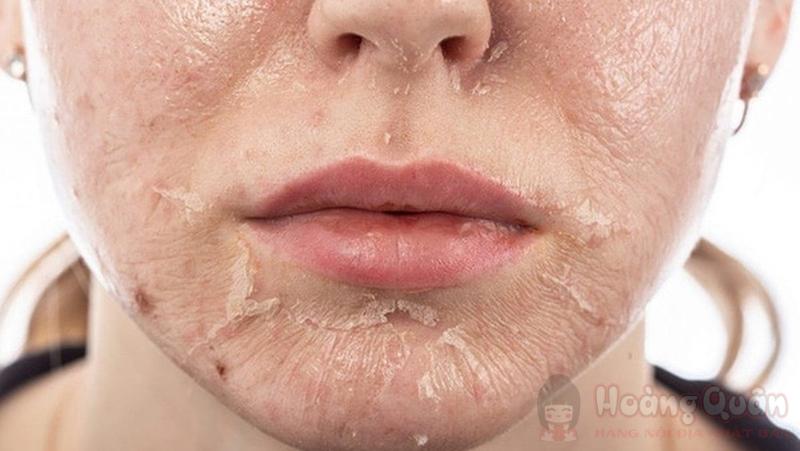 sau khi peel da có nên dùng vitamin c không