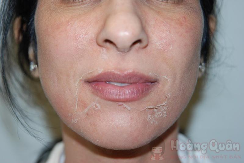 đang peel da có trang điểm được hay không