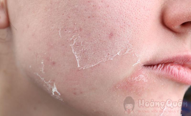 tìm hiểu peel da bao lâu thì đẹp