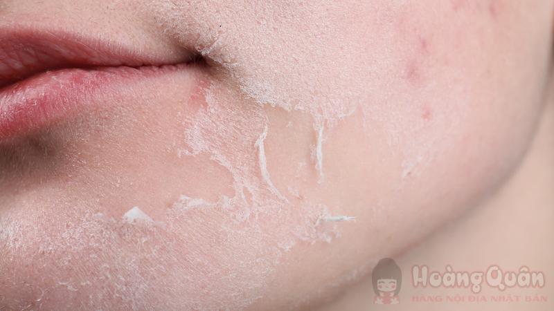 một số dấu hiệu sau khi peel da
