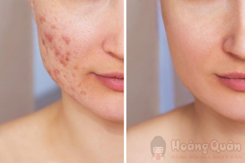 hướng dẫn Peel da vi tảo là gì