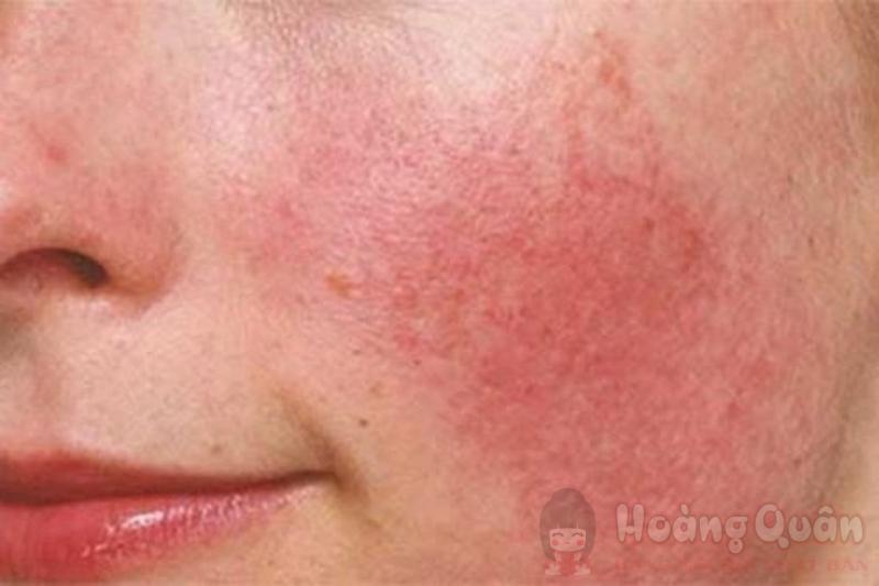 phương pháp peel da trị mụn