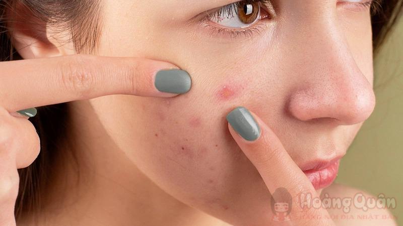 da mụn có peel được không