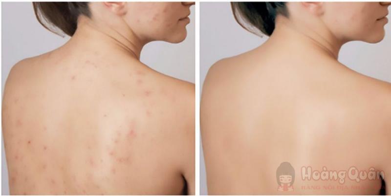 peel da lưng tại nhà có lợi ích gì