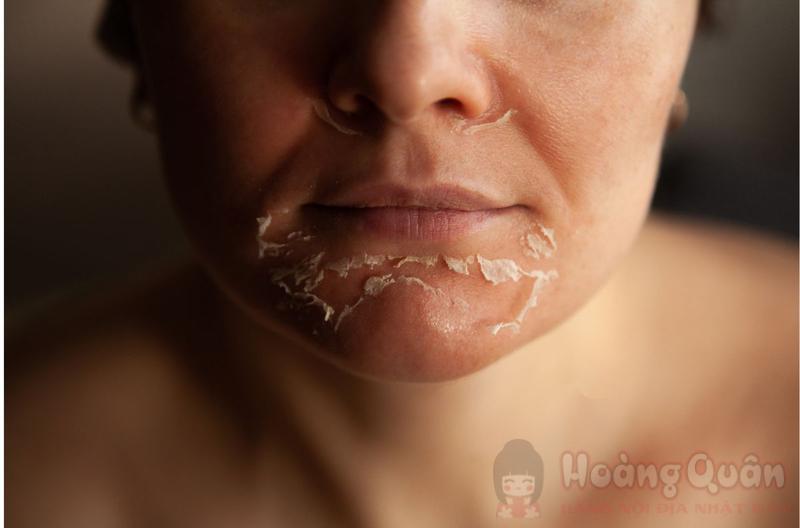 hướng dẫn peel da trị thâm