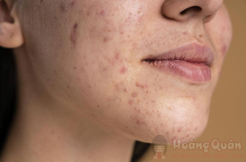 cách peel da trị thâm