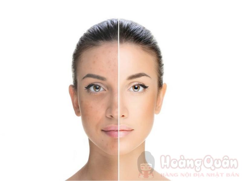 peel da trị thâm mụn