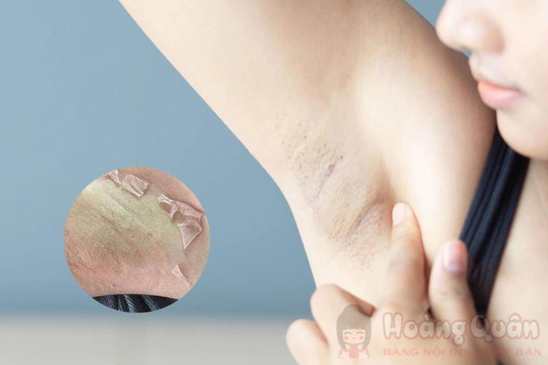 peel da trị thâm nách tốt không