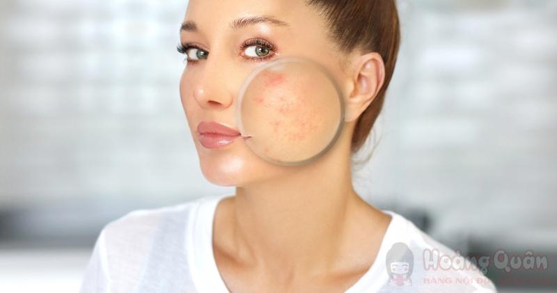 peel da trị sẹo