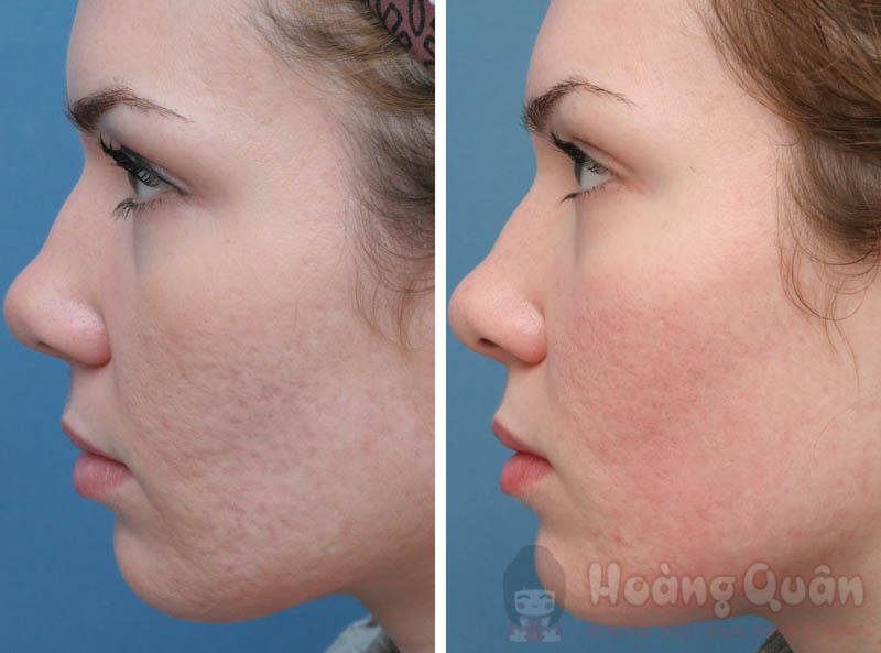 cách peel da trị sẹo