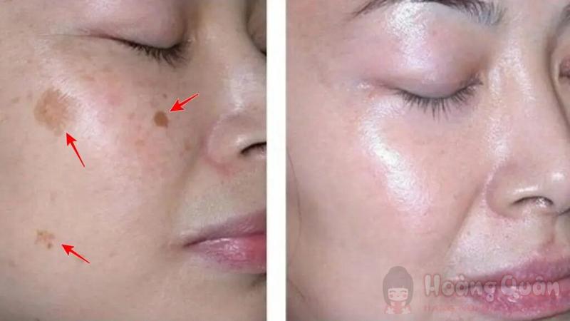 peel da có trị nám được không