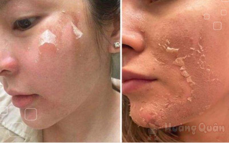 ai không peel da trị nám