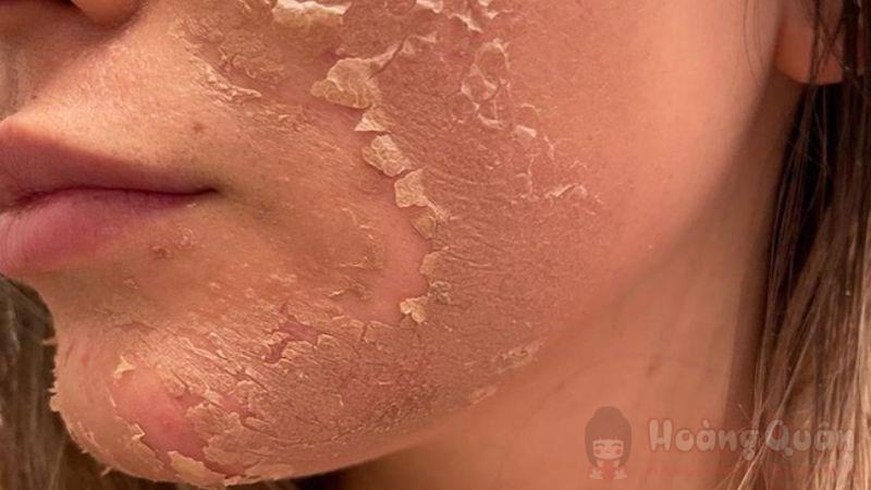 có nên peel da mặt không