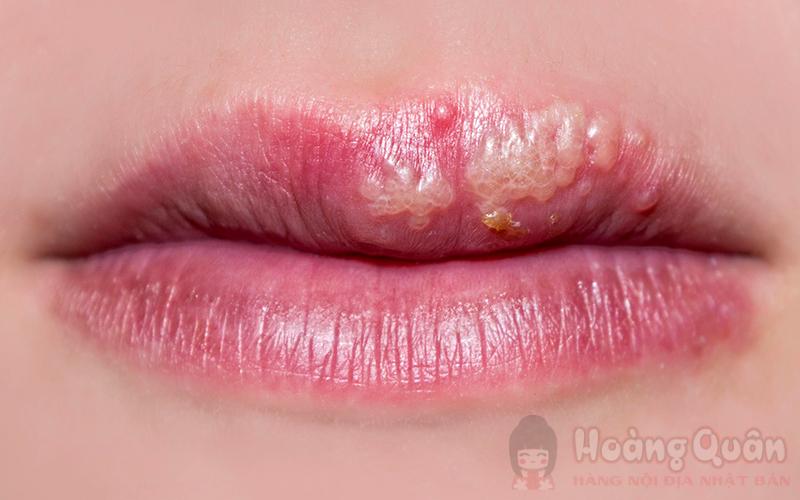 các tác hại của son dưỡng môi
