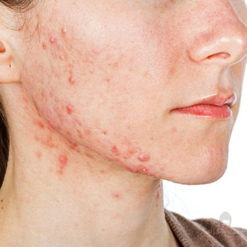 dấu hiệu dị ứng kem chống nắng