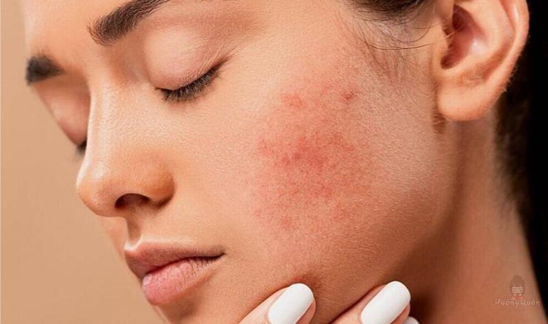 khắc phục dị ứng kem chống nắng