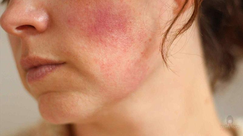 cách khắc phục dị ứng kem chống nắng