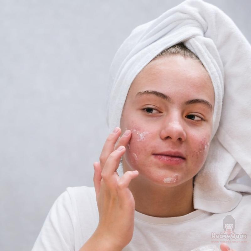 bị mụn có nên bôi kem chống nắng không