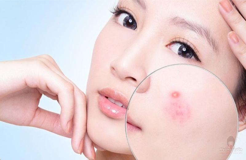 bị mụn có nên bôi kem chống nắng