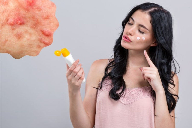 cách bôi kem chống nắng cho da mụn