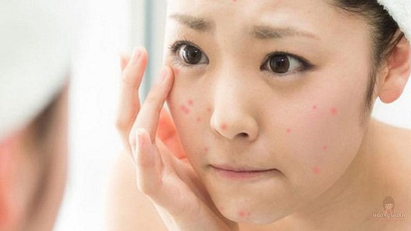 mới nặn mụn xong có nên bôi kem chống nắng không