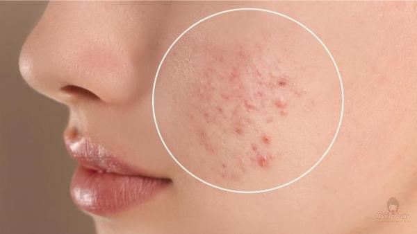 vì sao dùng kem chống nắng bị mụn